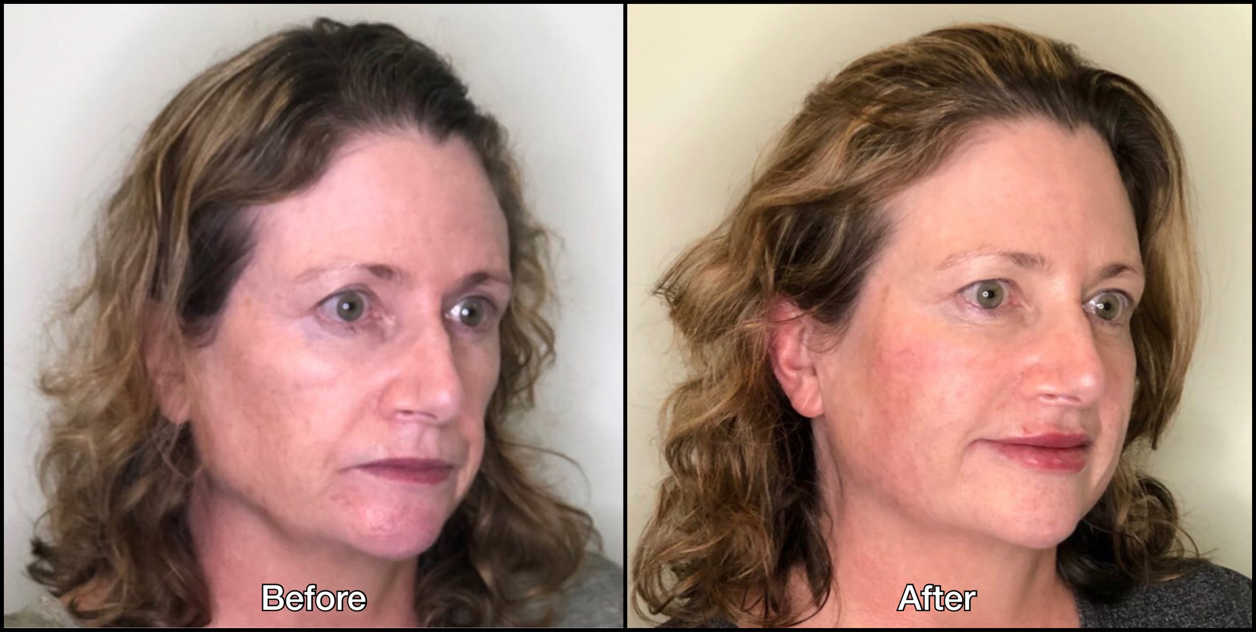 Dermal Filler — Sanctuary Cosmetic Clinics